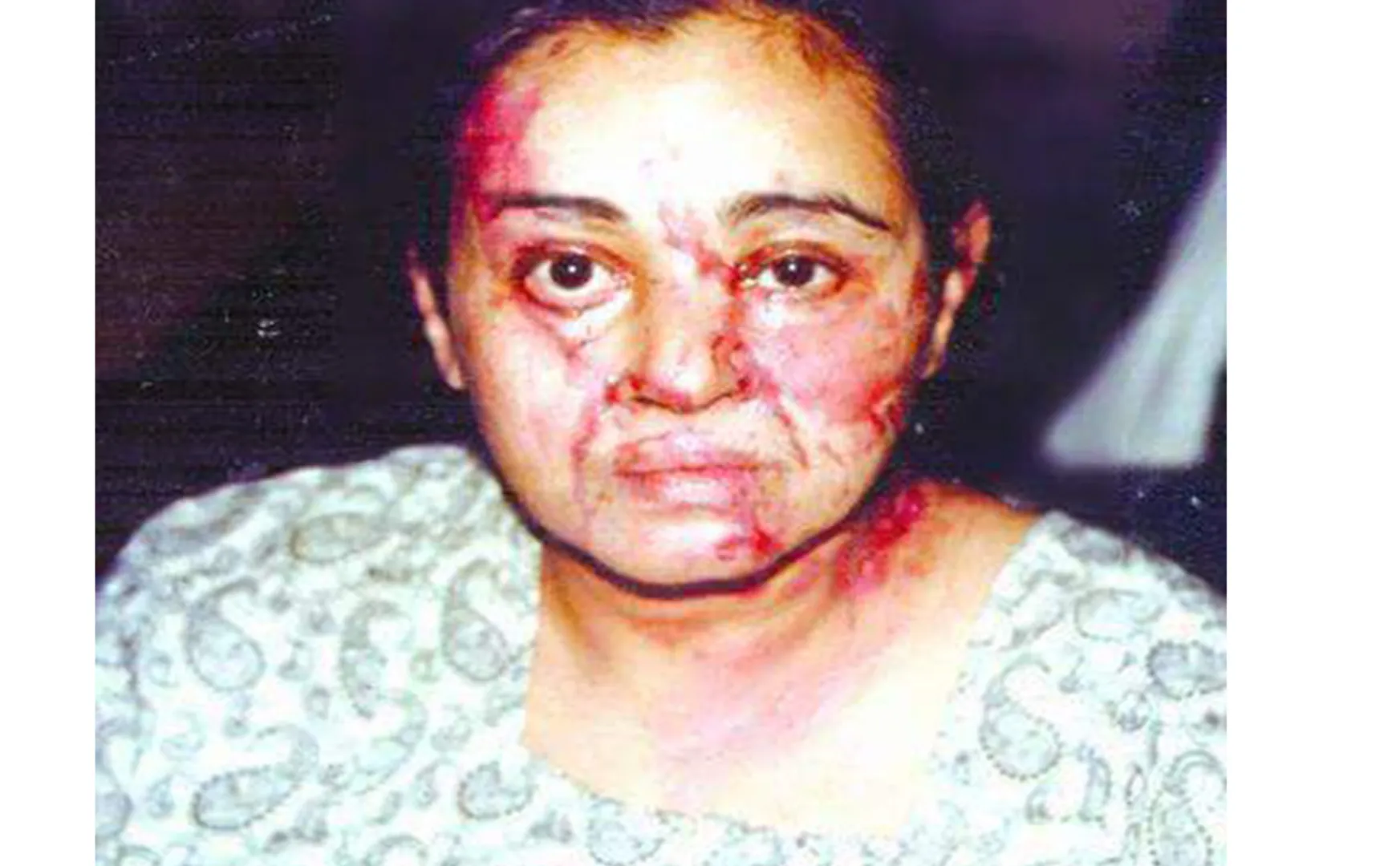 First acid attack on first female IAS